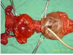 Pieza quir&uacute;rgica