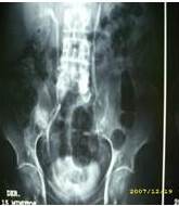 Urograf&iacute;a miccional: 09/07/2008: discreta dilataci&oacute;n pielo-calicial izquierda.