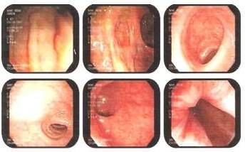 Colonoscopia 07/07/08: estudio normal.