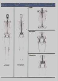 Gammagrama &oacute;seo 99Tc: no hay evidencias de diseminaci&oacute;n &oacute;sea.