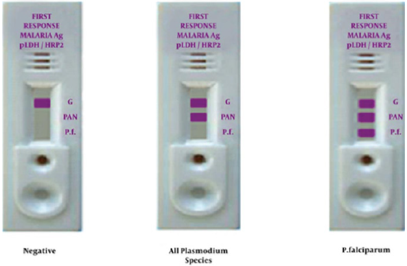 Pruebas diagnósticas rápidas para la malaria. (Fotografía cortesía de la Mashhad Universidad de Ciencias Médicas).