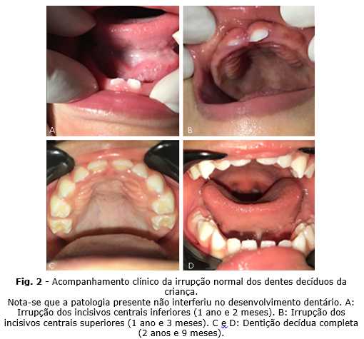 Exostose Palatina Bilateral Em Bebe