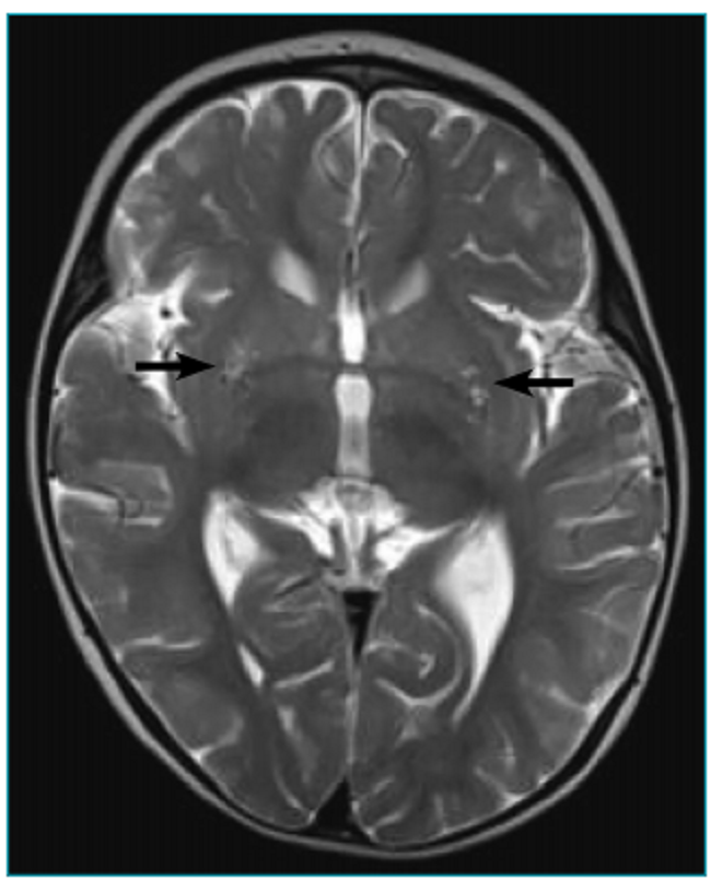 Corte axial da resson&acirc;ncia magn&eacute;tica cranioencef&aacute;lica (T2) da paciente com s&iacute;ndrome de Leigh e muta&ccedil;&atilde;o 8993T>G. As setas mostram o hipersinal lenticular bilateral.