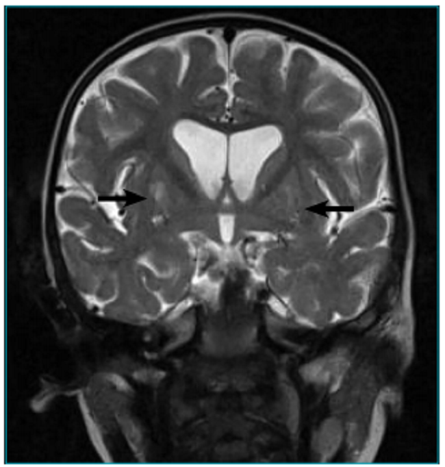 Corte coronal da resson&acirc;ncia magn&eacute;tica cranioencef&aacute;lica (pondera&ccedil;&atilde;o T2) da paciente com s&iacute;ndrome de Leigh e muta&ccedil;&atilde;o 8993T>G. As setas mostram o hipersinal lenticular bilateral.