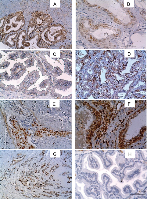 Photomicrography of nuclear immunostaining. A) Canine PIN tissue with
						score three for labeling intensity and four for number of labeled cells for
						p21. B) Human colon carcinoma. Positive control for p21 with scores two for
						labeling intensity and four for number of labeled cells. C) Normal canine
						prostatic tissue with one for labeling intensity and one for number of
						labeled cells for p21. D) Canine PIN with score two for labeling intensity
						and two for number of labeled cells for p27. E) Human colon carcinoma.
						Positive control of p27 with score three for labeling intensity and four for
						number of labeled cells. F) Canine PIA with score three for labeling
						intensity and four for number of labeled cells for p53. G) Mammary
						carcinoma. Positive control of p53 with score three for labeling intensity
						and three for number of labeled cells. H) Normal canine prostatic tissue
						with zero score for p-53. IHC, DAB, and HE counterstain. 200x and
						400x.