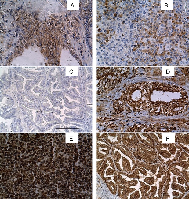 Photomicrography of nuclear, cytoplasmic and membrane immunostaining. A)
						Canine PIN tissue with score one for labeling intensity and three for number
						of labeled cells of cytoplasmic cyclin D1. B) Canine lymph node. Positive
						control of cytoplasmic cyclin D1 with score two for labeling intensity and
						two for number of labeled cells. C) Normal canine prostatic tissue with zero
						score for cyclin D1. D) Canine PC tissue with score three for labeling
						intensity and four for number of labeled cells for nuclear through
						cytoplasmic c-myc. E) Canine lymph node. Positive control of nuclear through
						cytoplasmic c-myc, with score two for labeling intensity and four for number
						of labeled cells. F) Normal canine prostatic tissue with score three for
						labeling intensity and four for number of labeled cells for c-myc. IHC, DAB,
						and HE counterstain. 200x and 400x.