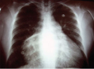 Telerradiografía de tórax con cardiomegalia global, con predominio de cavidades derechas