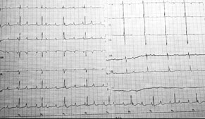 Electrocardiograma a su ingreso en donde se observa bloqueo AV completo