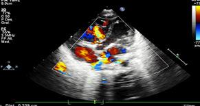 Ecocardiograma. Comunicación interventricular de 2 mm