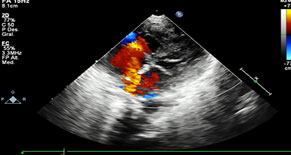 Ecocardiograma. Comunicación interauricular de 6 mm