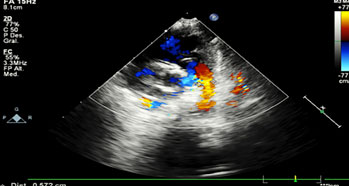Ecocardiograma. Persistencia del conducto arterioso de 5 x 6 mm