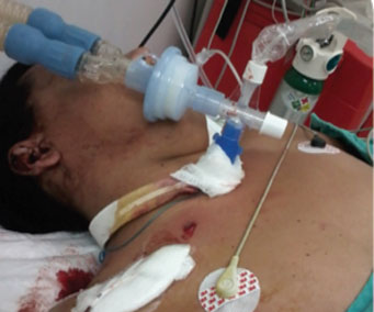 Paciente con traumatismo por arma de fuego (n&oacute;tese el orificio de entrada del proyectil)