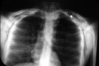 Se observa el doble neumot&oacute;rax sin cambios en el nivel mediastinal y con proyectil de arma de fuego alojado en la region apical del hemit&oacute;rax izquierdo

