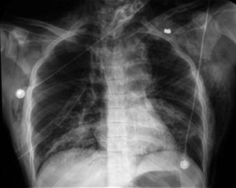 Despu&eacute;s de colocar una doble sonda endopleural, se evidenci&oacute; el ensanchamiento mediastinal compatible con compromiso a&oacute;rtico