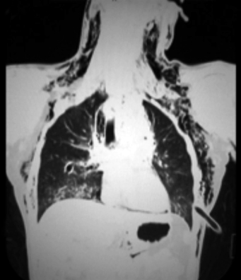 Toma frontal en la que se nota un peque&ntilde;o hematoma a nivel de tronco supraa&oacute;rtico del lado izquierdo, con neumomediastino