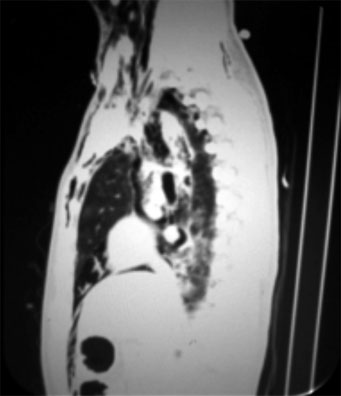 Toma lateral en la que se nota un peque&ntilde;o hematoma a nivel de tronco supraa&oacute;rtico del lado izquierdo, con neumomediastino