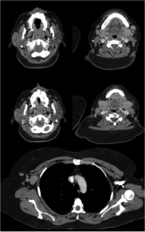 Tomograf&iacute;a
computarizada de cuello y toracoabdominal: gl&aacute;ndulas par&oacute;tidas con aumento de
volumen con densidad heterog&eacute;nea y &aacute;reas hipodensas.