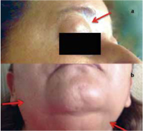 Tumefacci&oacute;n palpebral bilateral. Aumento de volumen de
gl&aacute;ndulas par&oacute;tidas y submaxilares