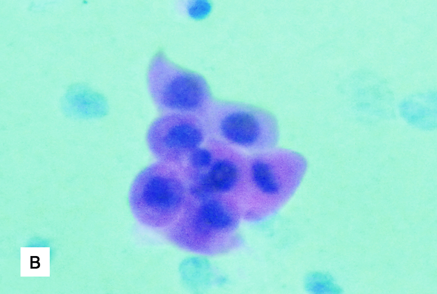 Microfotografías de dos citologías de esputo teñidas
con la técnica de Papanicolaou en donde se observa: