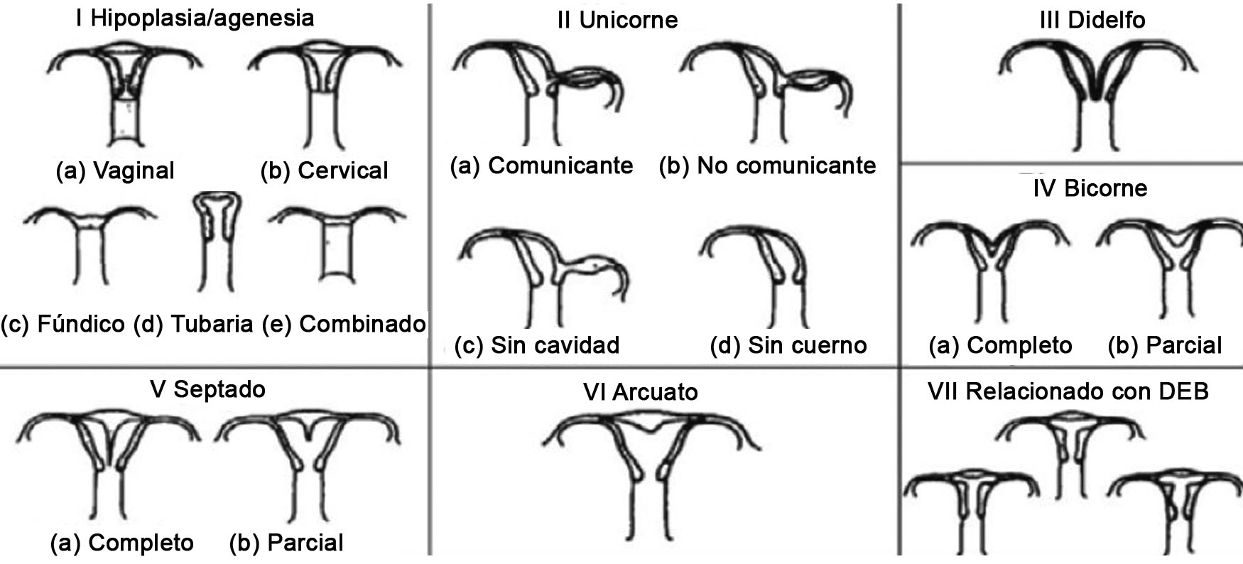 Utero Unicorne Con Cuerno Rudimentario Cavitado No Comunicante Caracterizacion Por Resonancia Magnetica