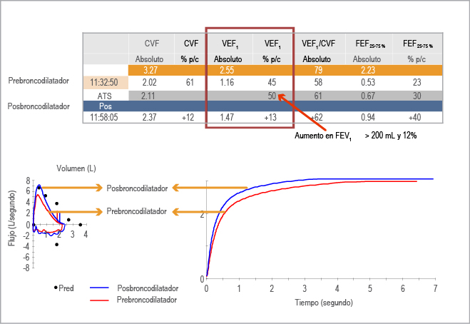 Se observa respuesta al broncodilatador en curva flujo-volumen y volumen tiempo. CVF = capacidad vital forzada, VEF1 = volumen espiratorio forzado en el primer segundo, FEF25-75 % = flujo espiratorio forzado 25-75 %. 