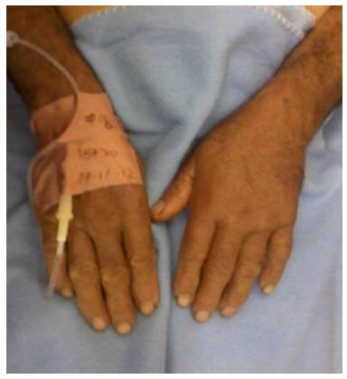 Appearance of bothriechis schlegelii bite. Edema in the left hand.