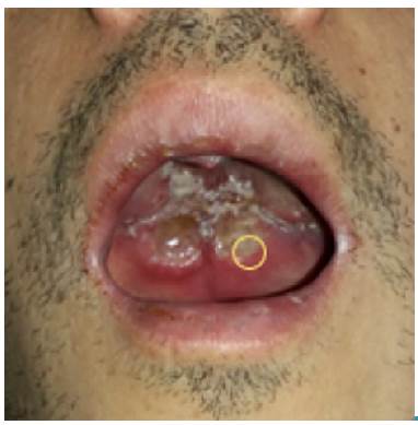 Ulcerated lesion in hard palate with necrotic borders. Circle: Delimitation of the site of the biopsy.