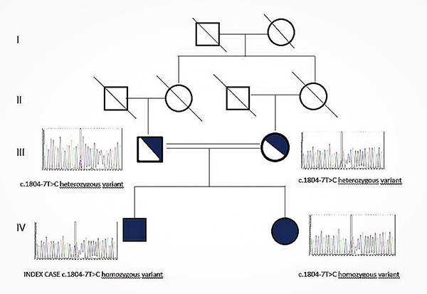 A Novel Col4a4 Gene Variant C 1804 7t C From A Focal Segmental Glomerulosclerosis Case To A Family With Alport Syndrome