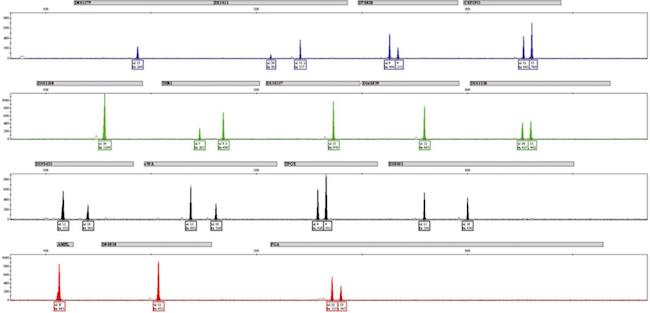 Perfil de STR. A figura representa um eletroferograma interpretado por um
software
específico. Os retângulos cinzas possuem o nome do marcador escrito e delimitam o intervalo de alelos conhecidos. Os picos representam os alelos (número de repetições), quanto mais à direita maior o tamanho do fragmento, consequentemente maior o número de repetições. Cada marcador (
locus
gênico) pode ter um pico (homozigoto) ou dois picos (heterozigoto), haja vista, que os humanos são diploides, um pico representa o alelo presente no cromossomo que herdou do pai e o outro pico o alelo no cromossomo que herdou da mãe. Em condições normais, o marcador que apresentar apenas um pico significa que ambos os cromossomos possuem o mesmo alelo. Para os marcadores com dois picos, em alguns deles, é possível perceber que há uma diferença grande de altura (desbalanço alélico), para humanos saudáveis se aceita uma diferença de até 30%, contudo as células imortalizadas ao longo das passagens podem apresentar essa diferença como resultado da degeneração genética, além disso, a presença de três ou quatro picos em um ou dois marcadores não é um evento raro.