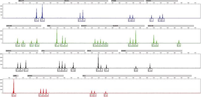 Perfil de STR mostrando uma contaminação. A identificação da mistura de DNA de dois ou mais indivíduos é indubitável, como já explanado cada marcador deveria apresentar no máximo dois picos (humanos são diploides), excepcionalmente aceita-se uma trissomia em um ou dois marcadores. Na imagem praticamente todos os marcadores apresentam tri- ou tetra- somia, ou seja, três a quatro picos indicando a contaminação cruzada entre dois ou mais indivíduos (linhagens celulares). O desbalanço alélico, ou seja, a diferença na altura entre dois picos dentro do mesmo marcador indica que aquele alelo está recebendo uma contribuição maior que o(os) outro(s) alelo(s).
