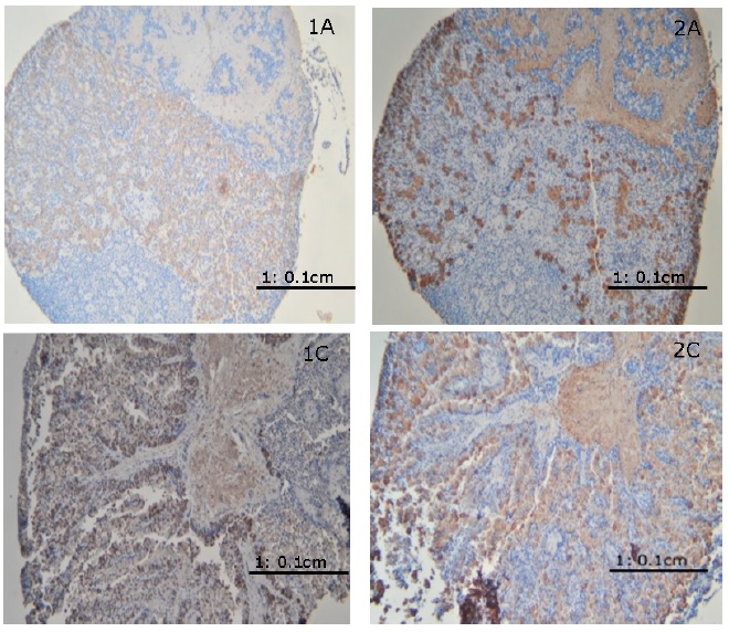 Secciones de
glándulas pituitarias de hembras de Prochilodus magdalenae, teñidas con
anticuerpos anti-GTH Iβ y anti-GTH Iiβ mostrando
inmunoreactividad (color café oscuro) en el citoplasma de los gonadotropos. Las
imágenes 1A y 2A corresponden a individuos inmaduros
(estado A), presentando mínima inmunoreactividad a los anticuerpos anti-GTH Iβ comparado con los
anti-GTH IIβ . Las imágenes 1C y 2C
corresponden a individuos maduros (estado C), presentando una mayor
inmunoreactividad a los anticuerpos anti-GTH Iβ comparado con los de
anti-GTH Iiβ .