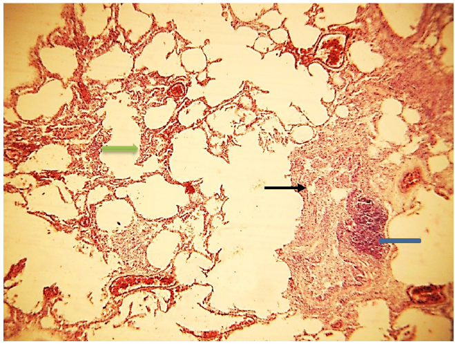PULMÓN BOVINO H/E.10X. NEUMONÍA
BRONCOINTERSTICIAL. CORTE DE PULMÓN DE TERNERO, NÓTESE ACTIVACIÓN DEL SISTEMA
LINFOIDE ASOCIADOS A BRONQUIOS (BALTS) (FLECHA AZUL), BRONQUITIS, BRONQUIOLITIS
Y ALVEOLITIS MONONUCLEAR MN (FLECHA NEGRA). SEPTOS INTERLOBULILLARES DILATADOS,
ENGROSAMIENTO LEVE DE SEPTOS INTERLOBULILLARES, VASOS SANGUÍNEOS CONGESTIONADOS
(FLECHA VERDE). LESIONES COMPATIBLES CON LOS VIRUS RIB Y PI-3. FOTOGRAFÍA
AUMENTO 10X, TOMADA POR JOSÉ V. CASTAÑEDA T.