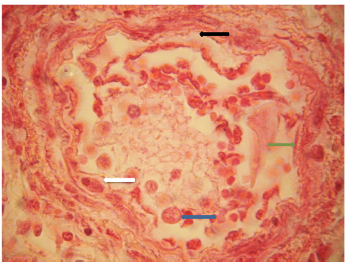 CORTE HISTOLÓGICO DE PULMÓN
BOVINO-TERNERO. H/E. 40X. CORTE DE BRONQUIOLO, BRONQUIOLITIS NECROTIZANTE DE
TIPO MIXTO. OBSÉRVESE HIPERPLASIA EPITELIO BRONQUIOLAR (FLECHA BLANCA),
DESPRENDIMIENTO Y NECROSIS DEL EPITELIO BRONQUIOLAR (FLECHA NEGRA), EN LA LUZ
DE LOS BRONQUIOS ABUNDANTE MATERIAL EOSINOFÍLICO MEZCLADOS CON CÉLULAS
MONONUCLEARES, POLIMORNUCLEARES Y MACRÓFAGOS ALVEOLARES (FLECHA AZUL).
FORMACIÓN DE SINCITIO CELULAR (FLECHA VERDE). ; LESIONES COMPATIBLES CON RIB Y
PI3. FOTOGRAFÍA AUMENTO 10X, TOMADA POR JOSÉ V. CASTAÑEDA T.