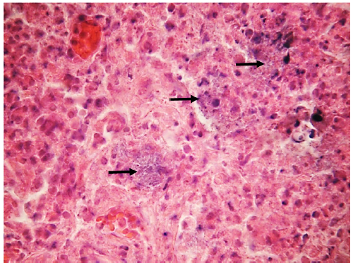 CORTE HISTOLÓGICO DE PULMÓN
BOVINO-TERNERO. H/E. 40X. OBSÉRVESE EN EL CORTE DE PULMÓN, NEUMONÍA DE TIPO
MIXTA, INFILTRADO MIXTO COMPUESTO POR CÉLULAS MONO Y POLIMORFO NUCLEARES,
ESTRUCTURAS BASOFÍLICAS DE MORFOLOGÍA BACILAR (FLECHAS NEGRAS), QUE PUEDEN
CORRESPONDER A COLONIAS BACTERIANAS. MICROFOTOGRAFÍA 100X, TOMADA POR JOSÉ V
CASTAÑEDA T.