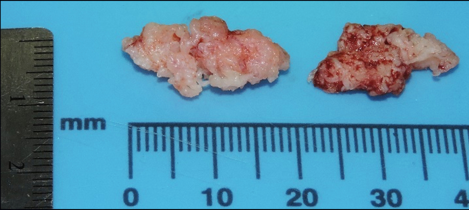 Fragmentos de tejido blando obtenidos de la biopsia incisional