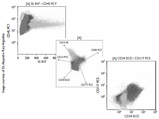 Bone marrow multiparametric flow cytometry from a patient with myeloid leukemia. Blasts (red) show bimodal expression of CD45 antigen and coexpression of CD34 and CD117 early antigens. Differing from normal granulocytes (green), blasts express very little CD13 and CD15 maturation antigens.