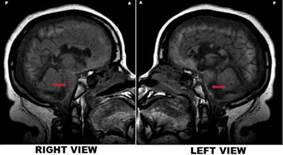 Jahi McMath's MRI - T1 sagittal right vs. left views. Note. Her MRI showed preservation of intracranial structures but vast abnormalities, documented nine months after a cardiac arrest: remarkable preservation of cortical and brainstem gross anatomy with unexpected relative slight atrophy despite cortical laminar necrosis, demyelination, and cystic encephalomalacia in the centrum semiovale, corpus callosum, and posterior pons and medulla. It also showed a massive lesion in the posterior regions of the pons, lateralized to the left(arrows).