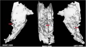mri - 3D reconstruction of right, central and left views. Note. The left arrows show a huge lesion at the pons, lateralized to the left side in its posterior region. The lateral regions of the pons and mesencephalon are relatively spared.