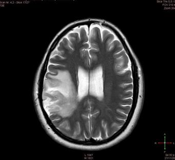 Sujeto 2. Resonancia magn&eacute;tica pre-operatoria con lesi&oacute;n fronto- parietal derecha.