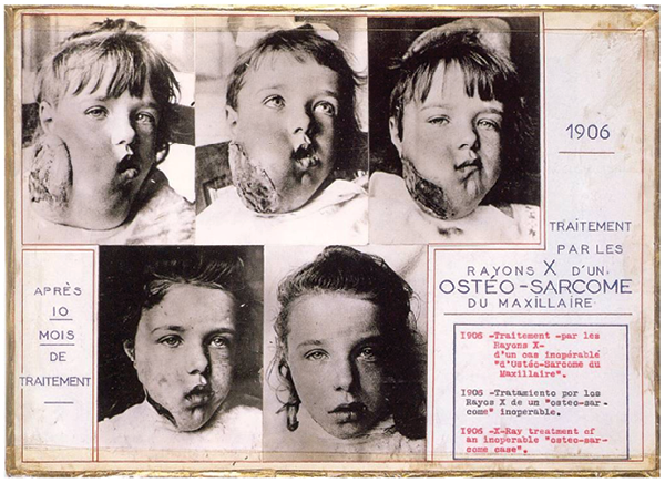 Osteosarcoma tratado con rayos X fotografa annima 1906