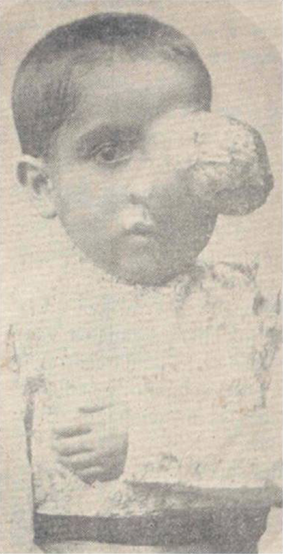 Nio de nueve aos con un enorme sarcoma del maxilar superior