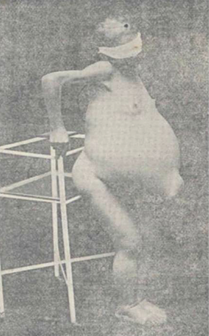 Tumor en un rin en Mercedes Parra vista de perfil