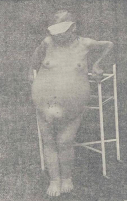 Tumor en un rin en Mercedes Parra vista de frente