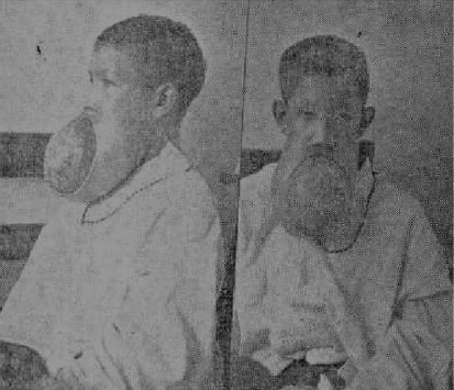 Enorme tumor del maxilar inferior en un joven de 16 aos