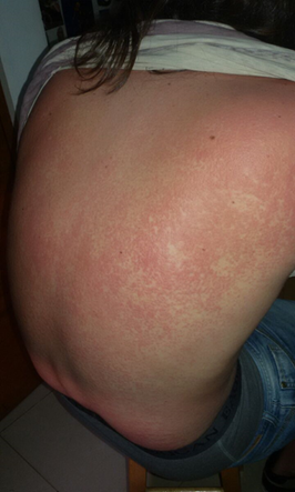 Figura 1. Placas
edematosas y m&aacute;culas eritematosas confluentes generalizadas.