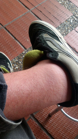 Figura 2. Edema de
miembros inferiores.