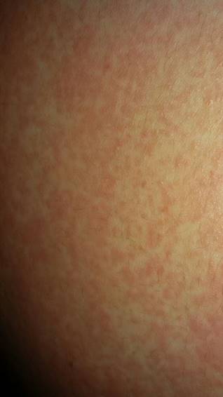 Figura 3.
Persistencia de lesiones.