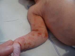 Figura 1. Lesiones en
extremidades el primer d&iacute;a de vida.