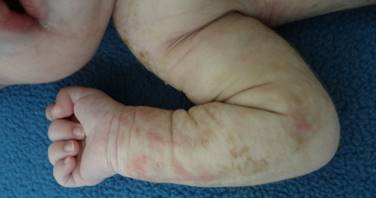 Figura 2. Lesiones en
extremidades al cuarto d&iacute;a del nacimiento.