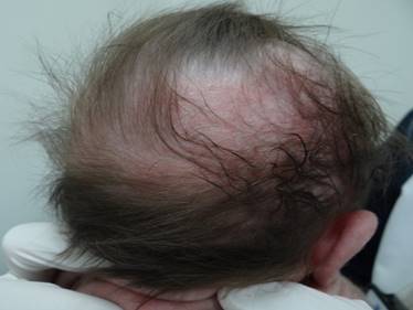 Figura 3. Lesiones en
cuero cabelludo al cuarto d&iacute;a del nacimiento.